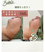 初回限定✨ 🌻夏本番🌻針を使わない小顔フェイシャル5ml