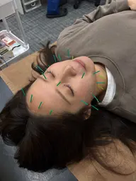 【美容鍼】通常6,000円 → 3,000円　初めての美容鍼でも安心の施術です🌿
