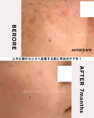 【全営業時間】アラサーからのシミくすみケア!水素高周波のWアプローチ!フェイシャルエステ体験