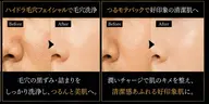 ハイドラ毛穴フェイシャル+つるモテパック