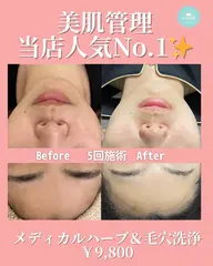 【平日限定】毛穴洗浄×全顔メディカルハーブピーリング🌿【剥離/ダウンタイムなし】