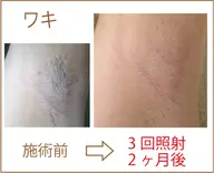 最後の脱毛に！脱毛カウンセリングをされた方に無料で１回！脇or手の甲の脱毛をプレゼント