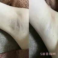 部分脱毛