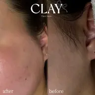 産毛すっきり✨ 顔ワックス／フェイスワックス［2回SET］［簡単化粧水仕上げ］赤ちゃん肌に👶🩵