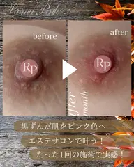 黒ずみ改善♪【RomaPink/ローマピンク★バストトップ(乳輪)】