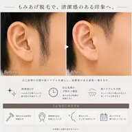もみあげ脱毛