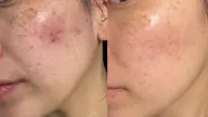 【ご新規様🌿赤み・肌荒れ・ゆらぎ】慢性的な肌荒れや季節の変わり目にゆらぎやすい方、赤みや乾燥が気になる方へ。