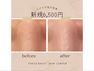 【毛穴の黒ずみ・角栓・いちご鼻が気になる方へ】ハイドラ毛穴洗浄フェイシャル＋PDRN美白美容液導入潤いあふれる水光肌へ