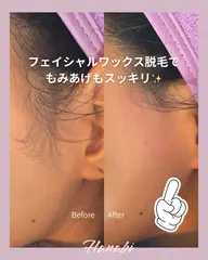 【くすみ・産毛・角質を除去❣️】お顔専用ワックスで産毛と古い角質を優しくOFF!くすみが晴れ、化粧ノリが格段に変わる肌へ