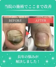 【初めての方】足の変形爪・深爪・肥厚爪ケア1指🦶