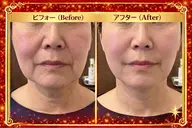 【たるみケア　小顔効果　食い縛りケア】最近たるみが・・