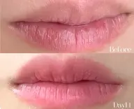 【最新技術！ローマピンク💋唇】黒ずみケアで本来のピンク肌へ🩷セルフホワイトニング1回(10780円分)プレゼント🎁