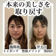 SNS顔出しOKの方🙆♀️40代〜50代限定!モニター募集中‼️痛くない小顔矯正💆♀️ほうれい線改善効果も⁉️