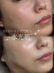 ミニモ限定価格【ニキビ/ザラつきにはこれ】ハーブピーリング、オイルデコルテ/肩/首マッサージ付き♪