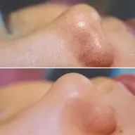 『 7・8月限定』【 鼻周りの毛穴角栓👃 】2回目までご利用可能〇