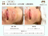 🌈人気No.1🌈繰り返す大人ニキビを本気でケア◎角質除去+温熱パック¥17,500→¥8,800