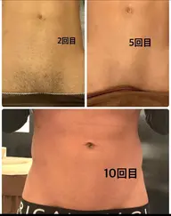 【5月限定】 🌸(男性VIO脱毛)🌸平均15回でつるつるに🌸2回目以降は5,000円🌸