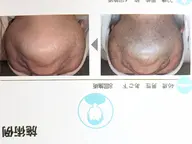 (メンズ)ハイブリッド美肌脱毛　顔全体