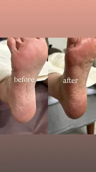 フット角質ケア