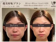 【小顔】オープンから圧倒的な指示｜小顔矯正＋全顔＆首ハイパーナイフEX2＋全顔＆首リンパマッサージ