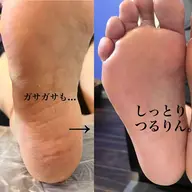 【足裏つるつる✨】フット角質ケア|ガサガサ・かかとの乾燥に