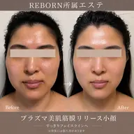 【プラズマ美肌×筋膜リリース】オールハンド小顔✨