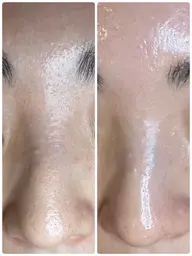 【当日予約限定】毛穴改善コース👃✨長年悩んでいた鼻の黒ずみ、詰まりが一回で改善!?当店1番人気コース♪