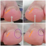 痛みなし!巻き爪ケアジェル