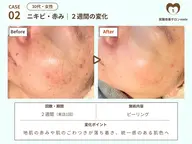 【9月中ご来店限定】🌟大人ニキビケア・毛穴🌟角質除去　¥6,600→¥5,500