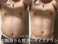 【レッドショット導入価格✨️】韓国発🇰🇷最新美容脂肪撃退🚨二の腕orお腹3cc導入✨️EMS、ラジオ波付き💪