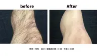 【メンズ】両手足脱毛