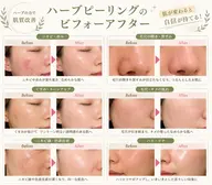【ダウンタイムや剥離無し!ハーブピーリング】