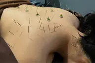 【慢性コリ特化】深部のコリに効かせる鍼(全身)