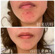 【美肌・毛穴ケア 陶器肌を目指したい方へ】美容鍼×フェイシャルエステによるスペシャルケア🪞🫧
