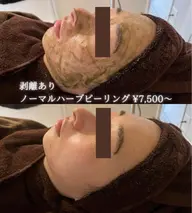 【キャンペーン】剥離ありノーマル・ハーブピーリング 🌿薄皮程度の皮剥けありダウンタイム3〜5日間あり✨