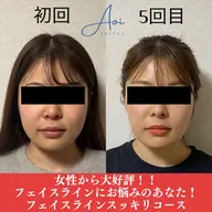 【美容鍼60本】フェイスライン・リフトアップケア60分 ¥8000→¥4000