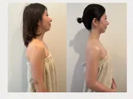 肩甲骨剥がし+巻肩調整