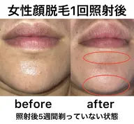 全身脱毛(男性はVIOを除く)