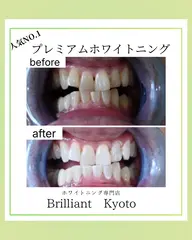 プレミアムホワイトニング