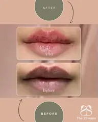 【韓国正規取扱サロン Lemella　ルメラ】ピンクに～唇 黒ずみメラニンケア