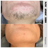 👨メンズヒゲ脱毛👨