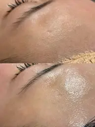 【毛穴・角質ケア】美肌フェイスワックス脱毛