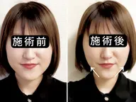 【ミニモ初回限定4,000円】むくみ・左右差|小顔矯正×EMS美容鍼50分