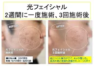 【未来の肌が今日から変わる💆肌投資】光フェイシャル