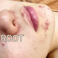 【肌荒れ・ニキビあとにはこれ‼️】朝、鏡を見るのが楽しみな素肌へ導くフェイシャルケア🪞✨
