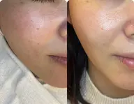 くすみ、たるみが気になっている方にオススメ💫リフトアップ×イオン導入(BeforeAfter写真にご協力頂ける方限定)
