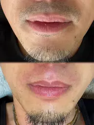 ヒゲワックス脱毛(洗顔＋鼻下ワックス＋鎮静パック)