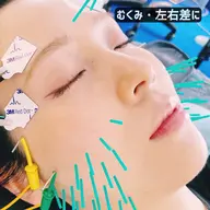 【朝のむくみ・顔の左右差に】小顔矯正×EMS美容鍼 50分