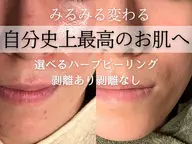 【モニター・剥離あり】ハーブピーリング