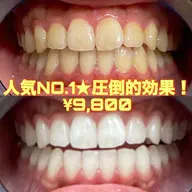 【1日2名様限定】🌈1番人気🌈【圧倒的効果！🔥】通常の6倍照射！セルフホワイトニング9,800円✨✨